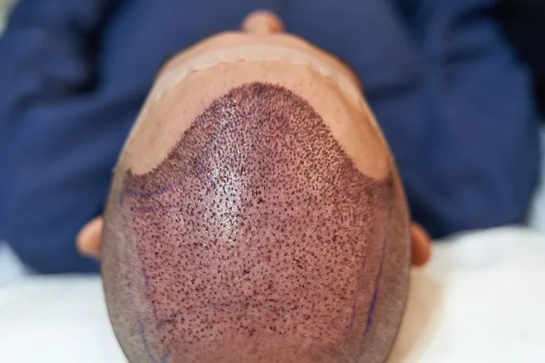 hair transplant surgeon